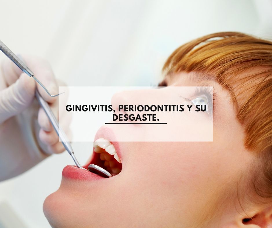 Gingivitis, periodontitis y su desgaste.