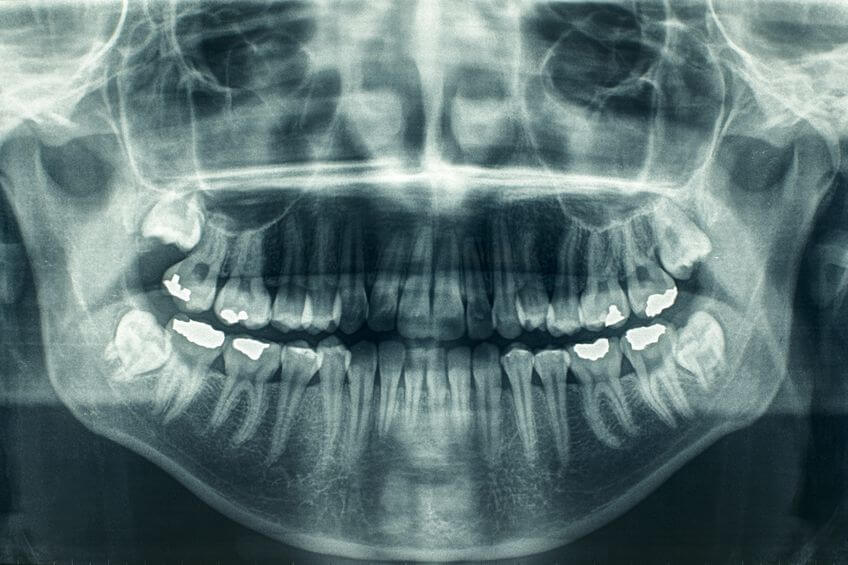 panoramic dental xray | Clínica Vermont Madrid
