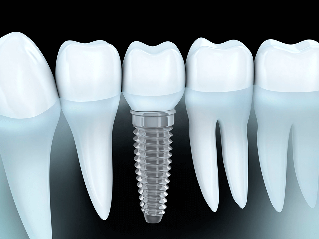 Especialistas Implantes Dentales Madrid