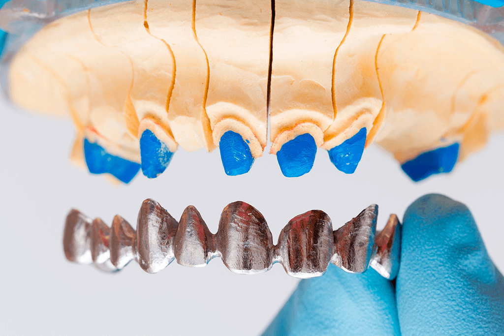 Odontología Rehabilitación integral Coronas de zirconio